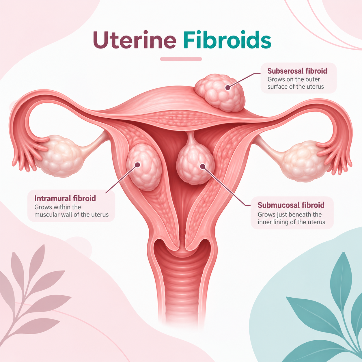 Everything You Need to Know About Fibroids